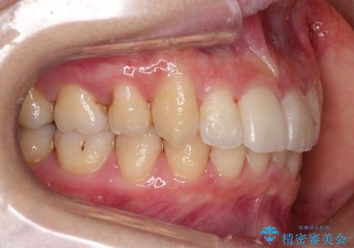 【がたつき・深い噛み合わせでお悩みの方必見】抜歯矯正症例(審美ワイヤー矯正)の治療後