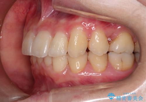 【がたつき・深い噛み合わせでお悩みの方必見】抜歯矯正症例(審美ワイヤー矯正)の治療後