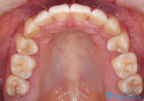 【がたつき・深い噛み合わせでお悩みの方必見】抜歯矯正症例(審美ワイヤー矯正)の治療後