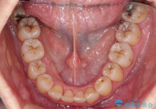 【がたつき・深い噛み合わせでお悩みの方必見】抜歯矯正症例(審美ワイヤー矯正)の治療後