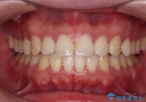 インビザラインで奥歯の咬み合わせと前歯のデコボコを改善の症例 治療後