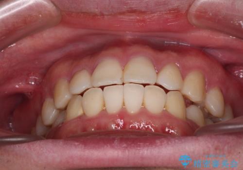 インビザラインで奥歯の咬み合わせと前歯のデコボコを改善の治療後