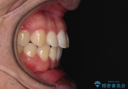 インビザラインで奥歯の咬み合わせと前歯のデコボコを改善の治療後