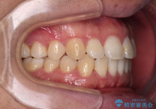 インビザラインで奥歯の咬み合わせと前歯のデコボコを改善の治療後