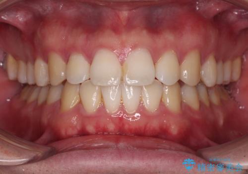 インビザラインで奥歯の咬み合わせと前歯のデコボコを改善の治療中