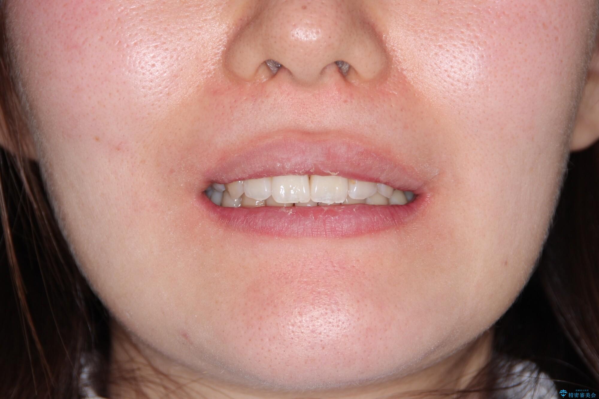 【がたつき・深い噛み合わせでお悩みの方必見】抜歯矯正症例(審美ワイヤー矯正)の治療後(顔貌)