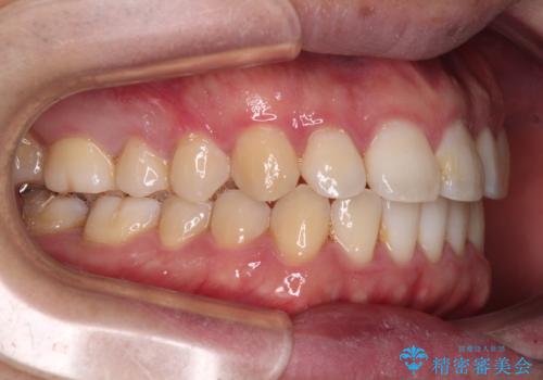 インビザラインで奥歯の咬み合わせと前歯のデコボコを改善の治療中
