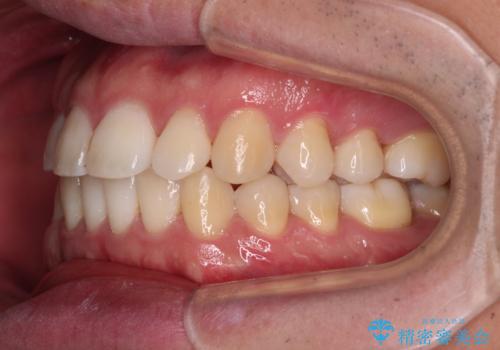 インビザラインで奥歯の咬み合わせと前歯のデコボコを改善の治療後