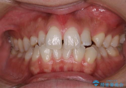 前歯の着色をきれいに除去の治療前