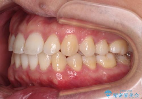インビザラインで奥歯の咬み合わせと前歯のデコボコを改善の治療中