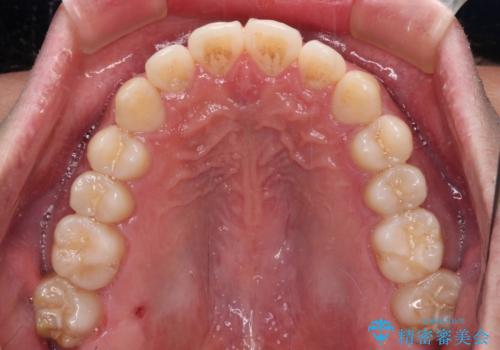 インビザラインで奥歯の咬み合わせと前歯のデコボコを改善の治療後