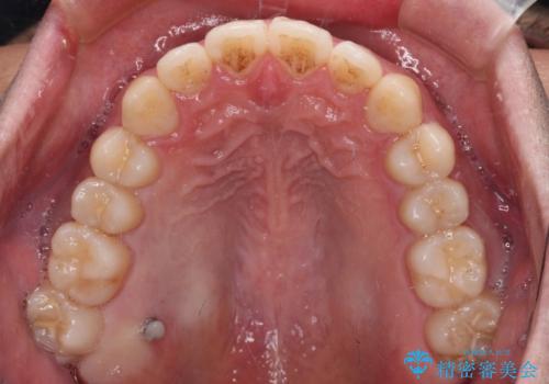 インビザラインで奥歯の咬み合わせと前歯のデコボコを改善の治療中
