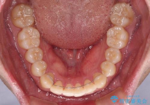 インビザラインで奥歯の咬み合わせと前歯のデコボコを改善の治療後