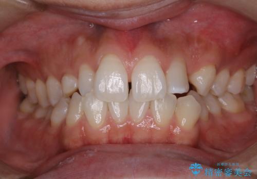 前歯の着色をきれいに除去の治療後