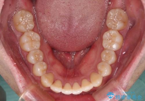 インビザラインで奥歯の咬み合わせと前歯のデコボコを改善の治療中