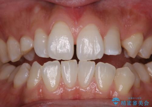 前歯の着色をきれいに除去の治療後