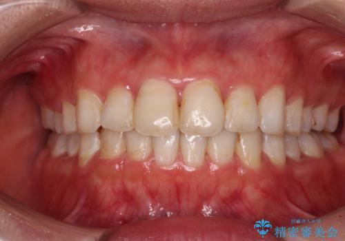 前歯の捻れを改善　インビザラインによる矯正治療の症例 治療後
