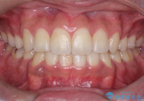【八重歯・がたつきでお悩みの方必見】抜歯矯正症例(審美ワイヤー矯正)の症例 治療後