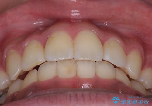 【八重歯・がたつきでお悩みの方必見】抜歯矯正症例(審美ワイヤー矯正)の治療後