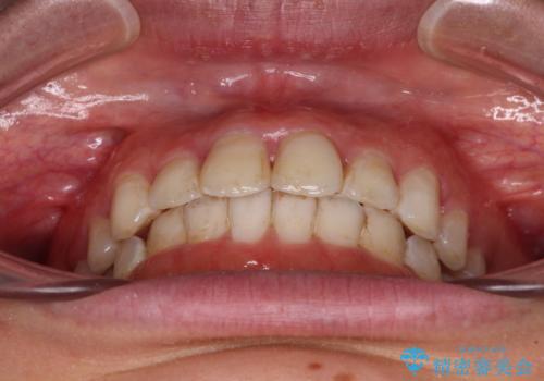 前歯の捻れを改善 インビザラインによる矯正治療の治療後