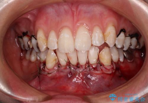 磨きすぎて傷が付くほどの歯根　歯肉移植術による根面被覆の治療中