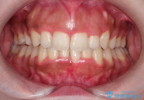 オフィスホワイトニングスペシャルコース+術前クリーニングの治療前