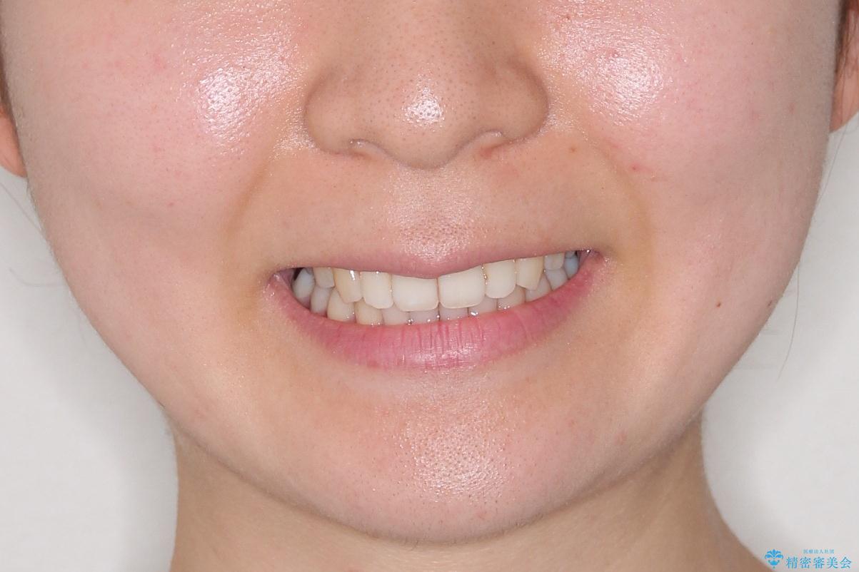 【前歯のがたつきでお悩みの方必見】インビザライン矯正の症例の治療後(顔貌)