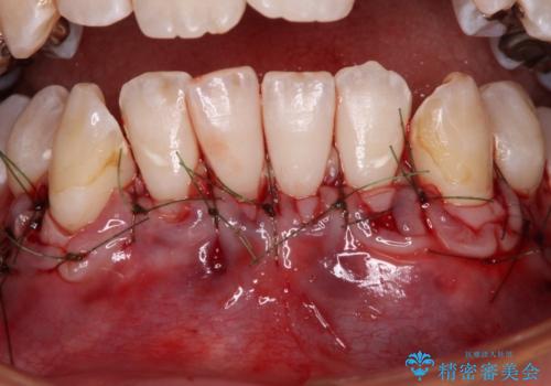 磨きすぎて傷が付くほどの歯根　歯肉移植術による根面被覆の治療中