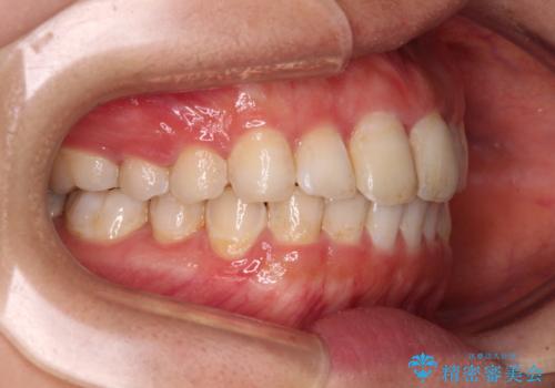 前歯の捻れを改善 インビザラインによる矯正治療の治療後