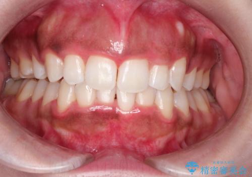 オフィスホワイトニングスペシャルコース+術前クリーニングの治療後