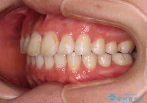 前歯の捻れを改善　インビザラインによる矯正治療の治療後