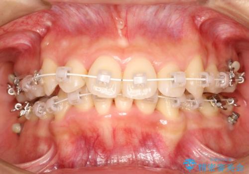 【八重歯・重度のがたつきでお悩みの方必見】抜歯矯正症例(審美ワイヤー矯正)の治療中
