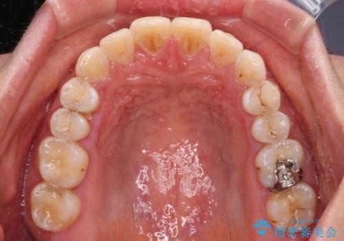前歯の捻れを改善 インビザラインによる矯正治療の治療後