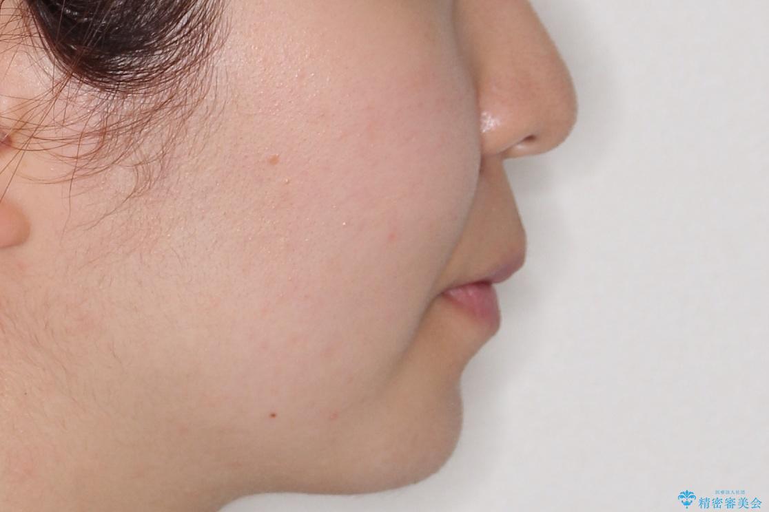 【前歯のがたつきでお悩みの方必見】インビザライン矯正の症例の治療後(顔貌)