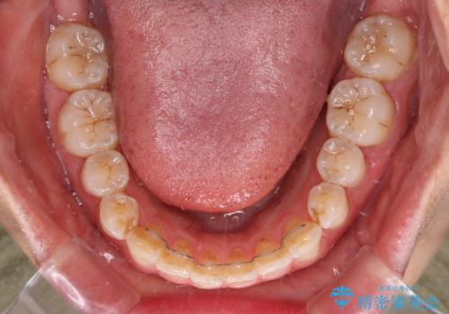 前歯の捻れを改善　インビザラインによる矯正治療の治療後