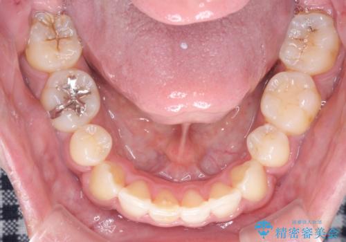 【八重歯・がたつきでお悩みの方必見】抜歯矯正症例(審美ワイヤー矯正)の治療後
