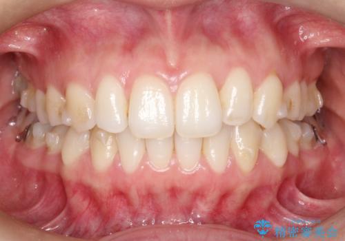 【前歯のがたつきでお悩みの方必見】インビザライン矯正の症例の治療中