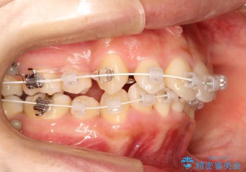 【八重歯・重度のがたつきでお悩みの方必見】抜歯矯正症例(審美ワイヤー矯正)の治療中