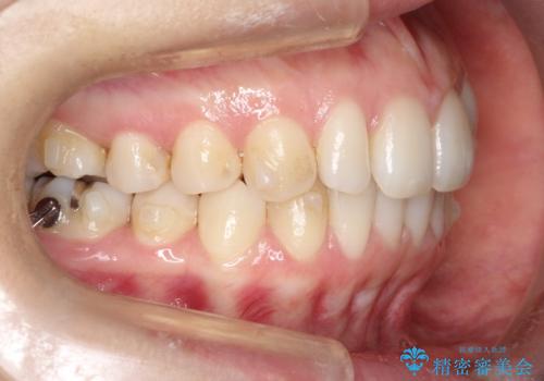 【前歯のがたつきでお悩みの方必見】インビザライン矯正の症例の治療中