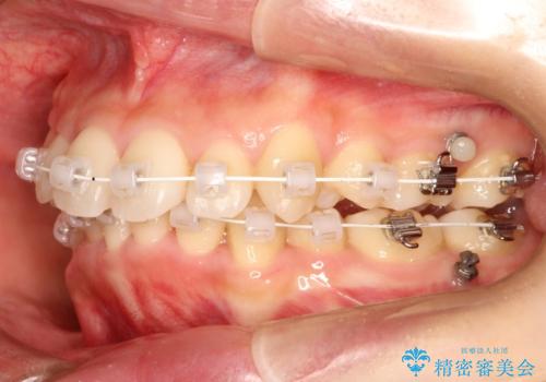 【八重歯・重度のがたつきでお悩みの方必見】抜歯矯正症例(審美ワイヤー矯正)の治療中