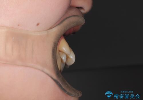 ガタガタの抜歯矯正を裏側ワイヤーを使っての目立たない矯正の治療前