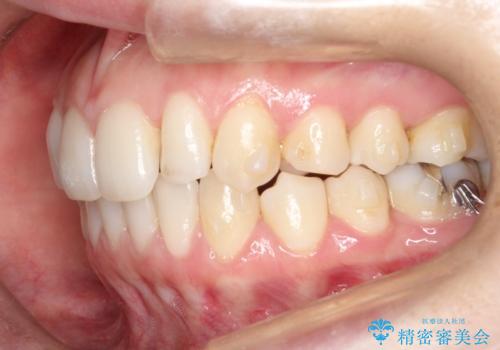 【前歯のがたつきでお悩みの方必見】インビザライン矯正の症例の治療中
