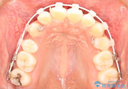 【八重歯・重度のがたつきでお悩みの方必見】抜歯矯正症例(審美ワイヤー矯正)の治療中