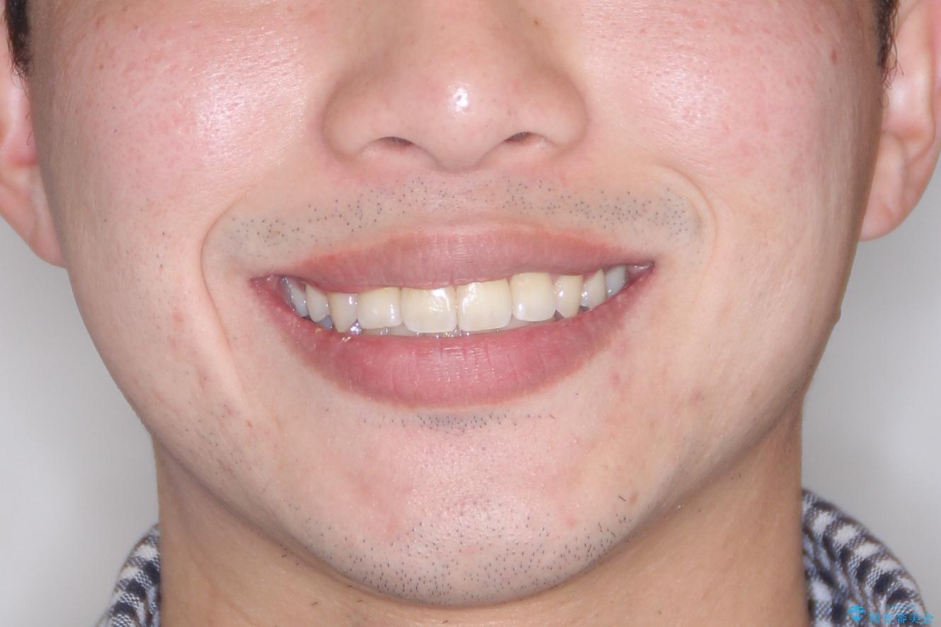 【八重歯・がたつきでお悩みの方必見】抜歯矯正症例(審美ワイヤー矯正)の治療後(顔貌)