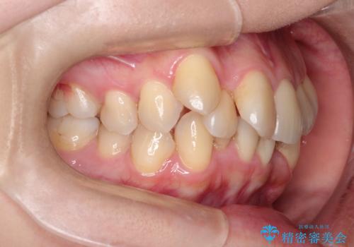 ガタガタの抜歯矯正を裏側ワイヤーを使っての目立たない矯正の治療前