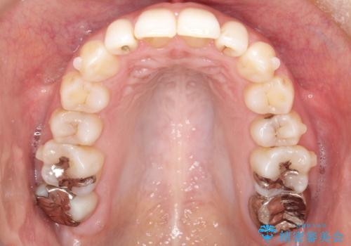 【前歯のがたつきでお悩みの方必見】インビザライン矯正の症例の治療中