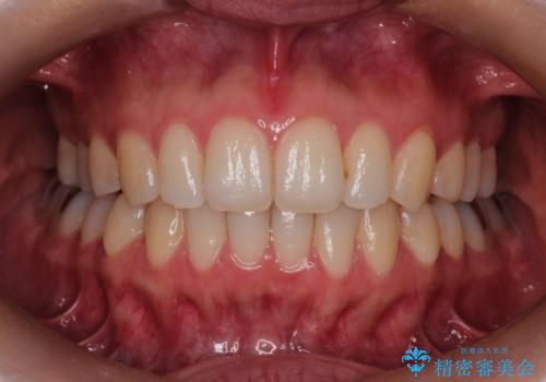 【前歯のがたつきでお悩みの方必見】インビザライン矯正の症例の治療後