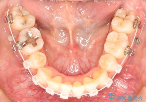 【八重歯・重度のがたつきでお悩みの方必見】抜歯矯正症例(審美ワイヤー矯正)の治療中
