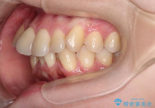 ガタガタの抜歯矯正を裏側ワイヤーを使っての目立たない矯正の治療前