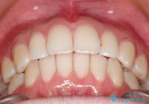 【前歯のがたつきでお悩みの方必見】インビザライン矯正の症例の治療後